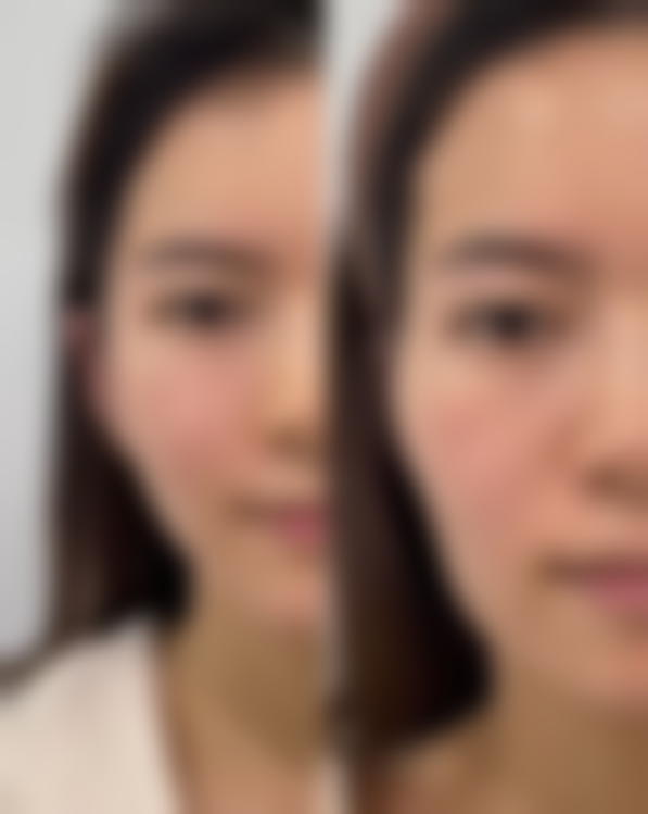 耳朵打耳洞长了疤痕疙瘩咋办？激光治疗有妙招