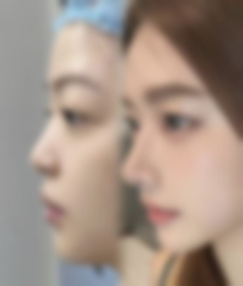 傅其兵医生高难度鼻综合怎么样可靠吗？