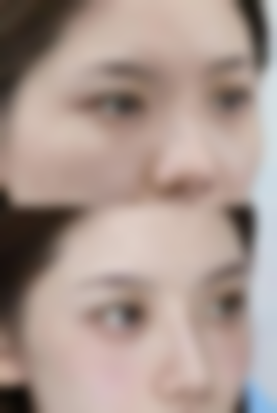 放射治疗：射线助力，抚平疤痕