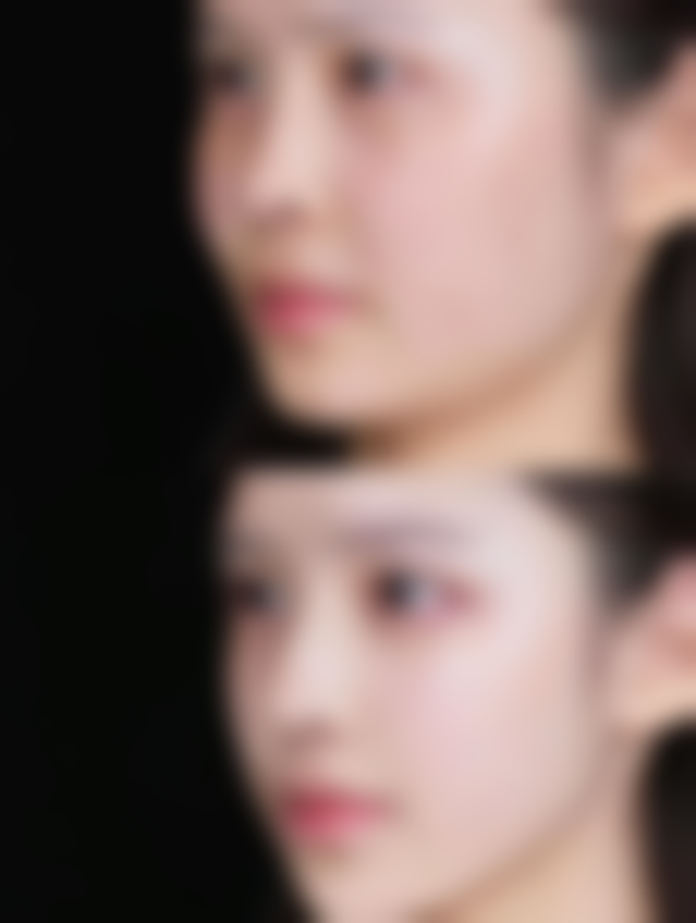 疤痕增生多久能软化？重度增生修复时间揭秘