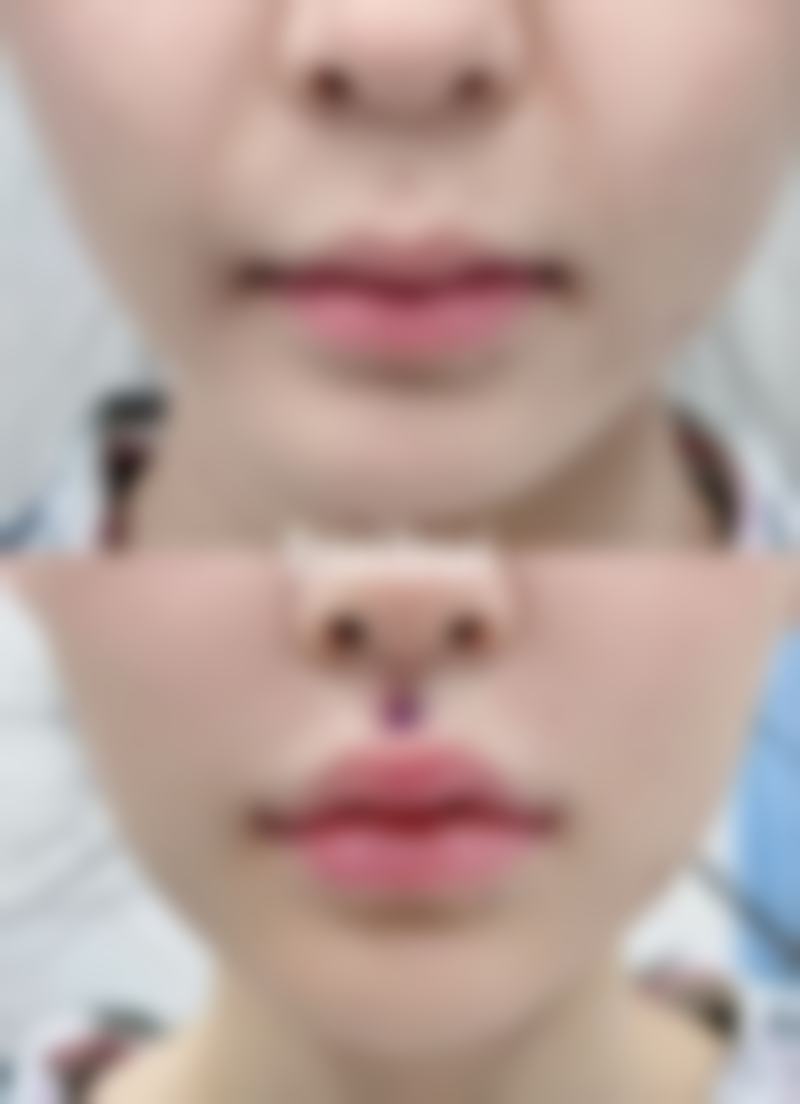 筋膜恒久无痕双眼皮:优势尽显魅力大