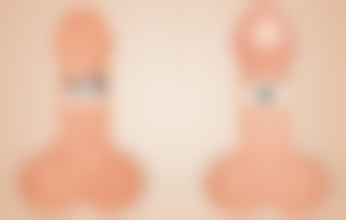 去眼袋后常见后遗症之皮下淤血