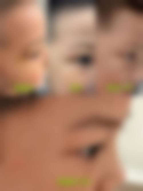 高英姝医生修复手术疤痕实例