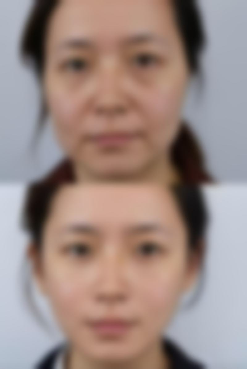 抽脂后成效的稳定期