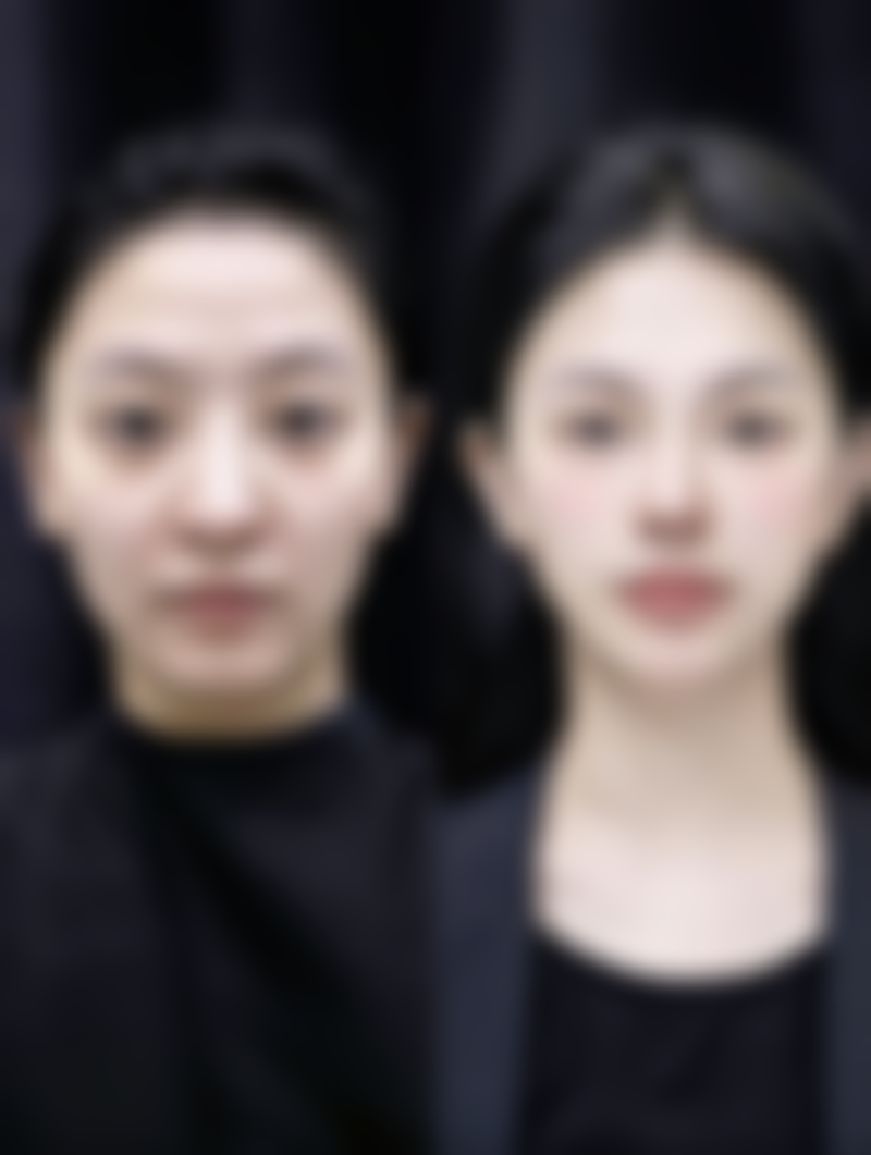 个人体质对抽脂成效显现时间的影响