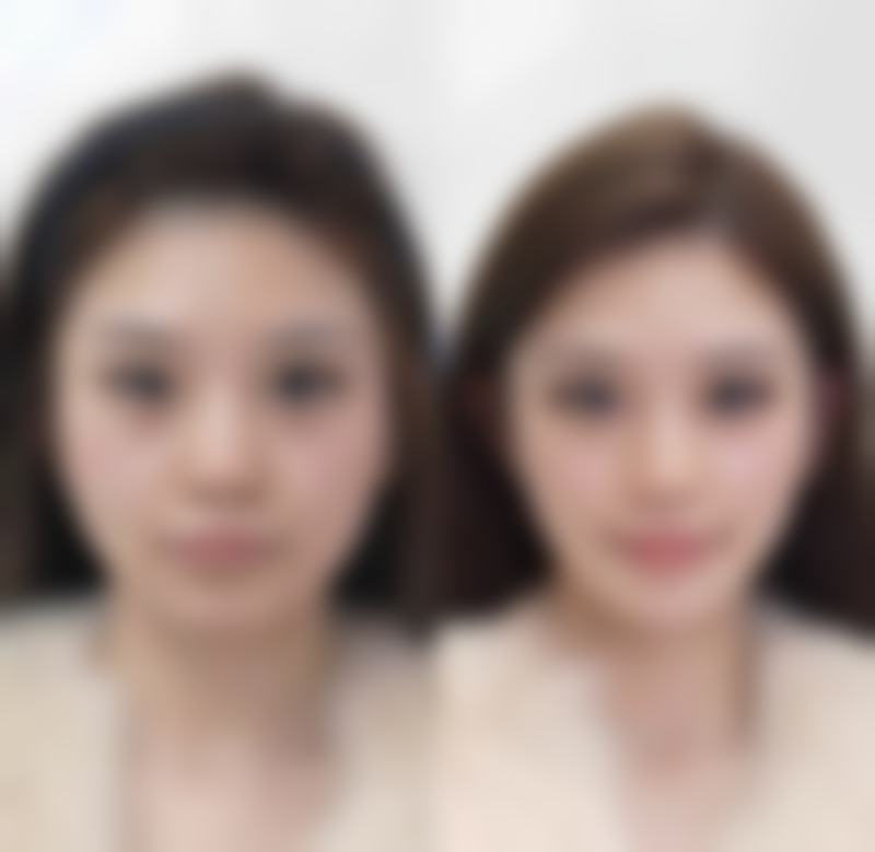 点痣留疤别犯难，手术治疗解忧患