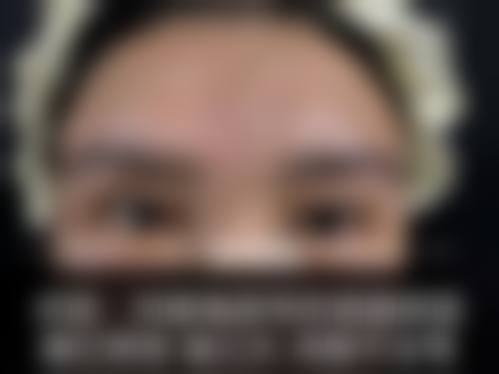 但汗乾医生眼部综合整形实例