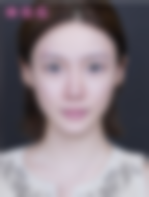 王坤医生植发实例