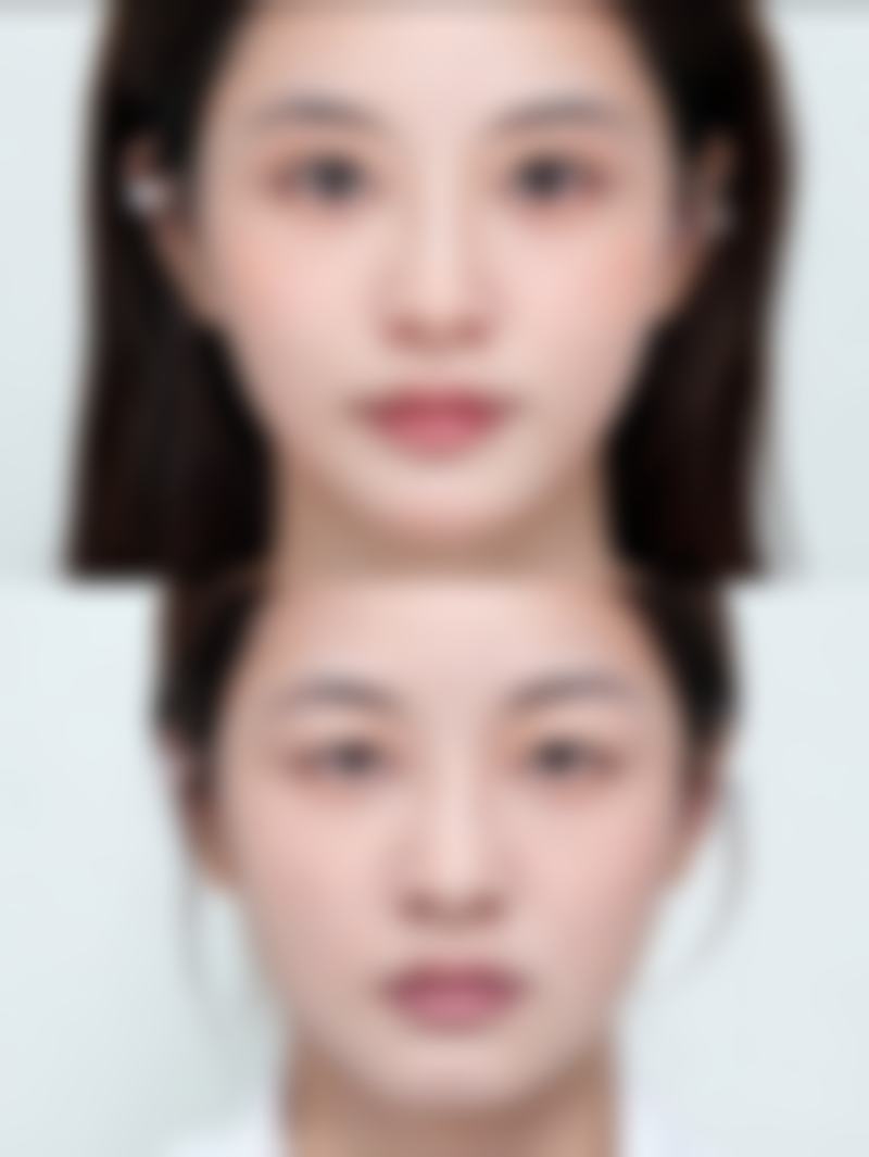 提眉和眼袋恢复周期大揭秘，1 - 3 个月主流恢复，分阶段护理助眼周形态稳定呈现 