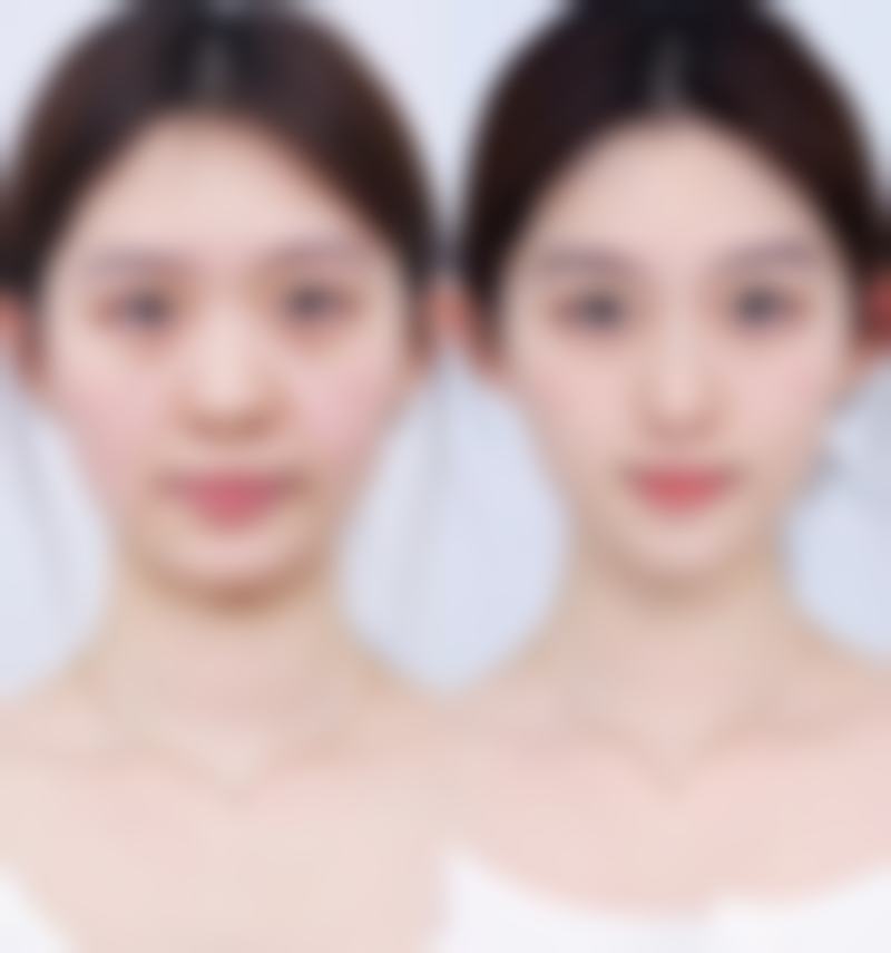 王晓伟医生重睑手术怎么样可靠吗？