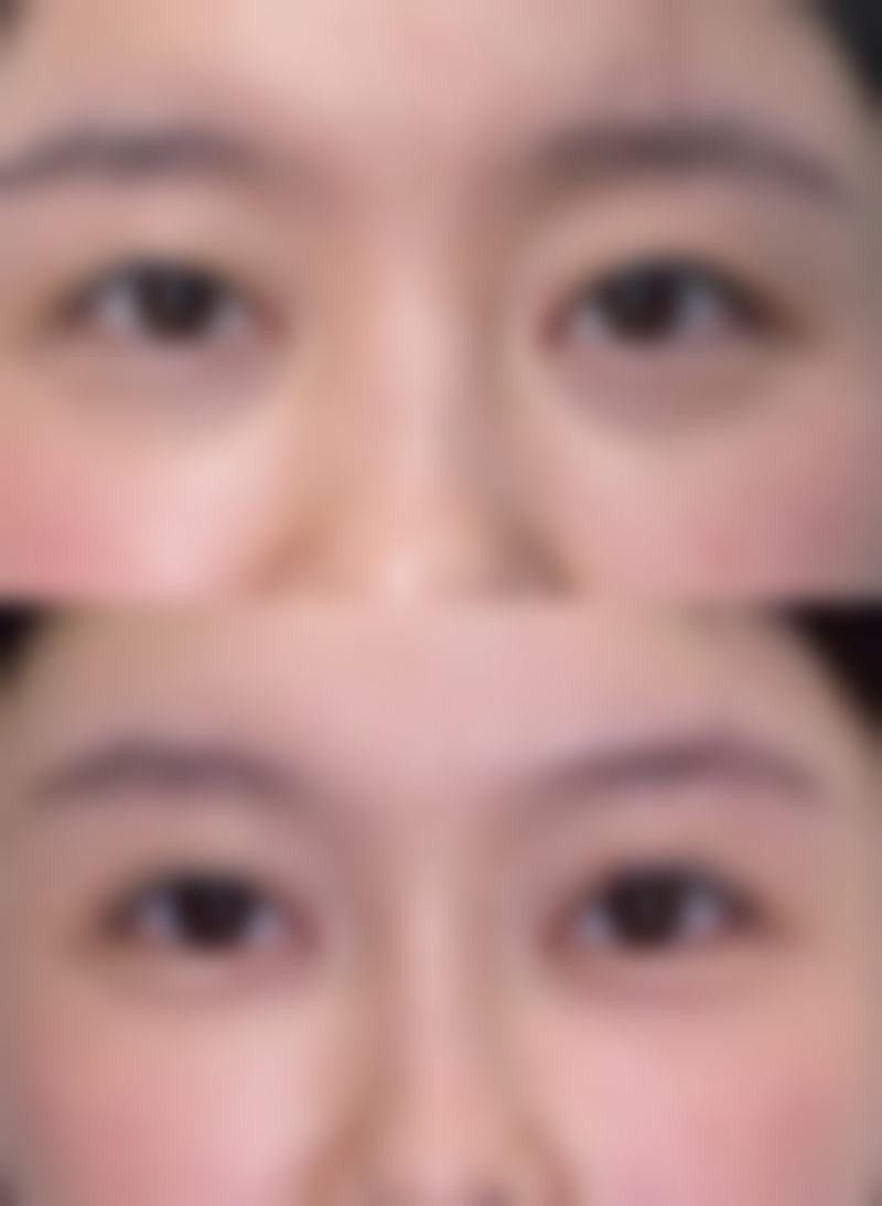 想确定能否割双眼皮？看看面部整体情况特别重要