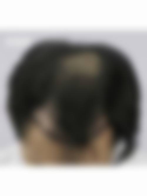 五、金华新生植发实例