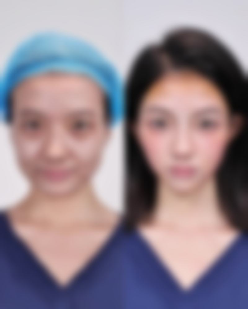 先做双眼皮再开眼角可行不?好处多多