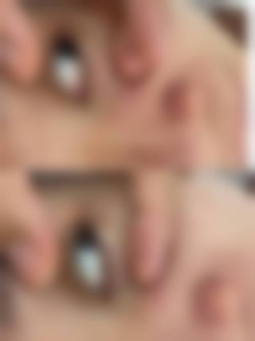 四、韩国眼角整形外科医院实例