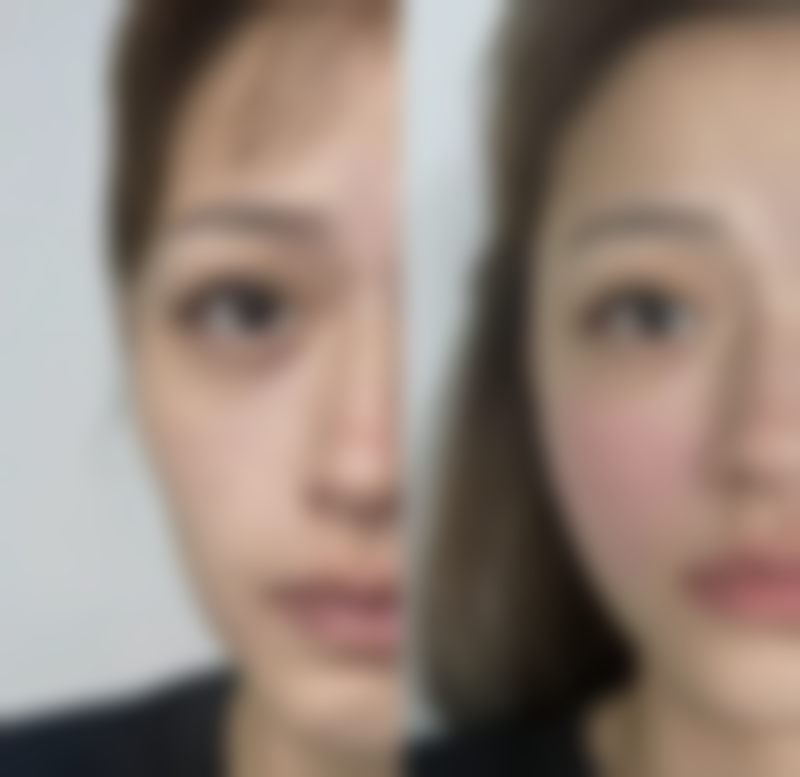 割完双眼皮一边肿一边不肿原因揭秘：手术、护理、个体差异及恢复差异全解析 