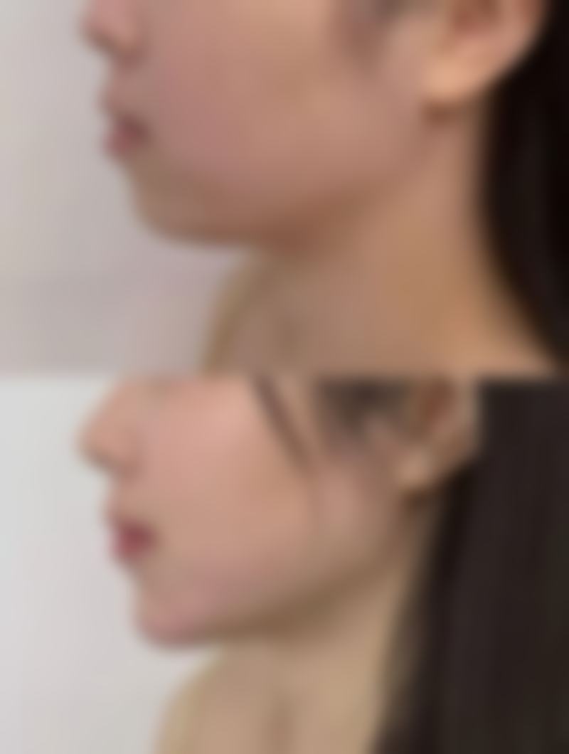 割完双眼皮一边肿一边不肿原因揭秘：术后护理因素