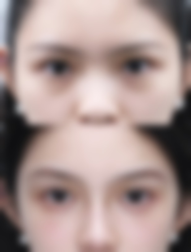 眼角下垂做双眼皮：手术成效怎么样？