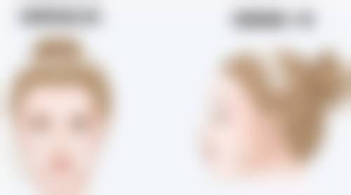 吸脂一个半月还能持续瘦吗？揭秘恢复周期、护理与个人基础对瘦身效果的影响 