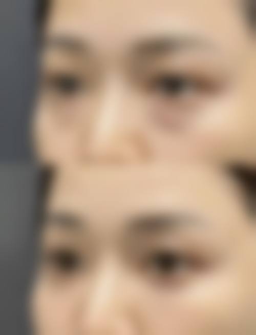 四、郑州那美整形医院实例