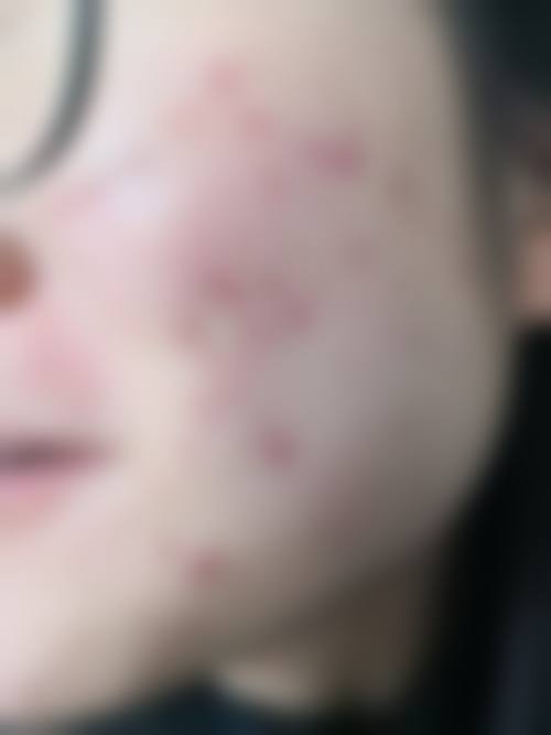 六、济南市皮肤病防治院美容科价格表：（仅供参考）