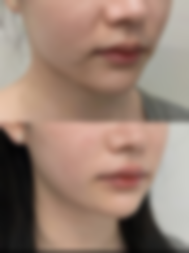 全切双眼皮究竟啥样？稳定持久改善多问题，千元预算拥有10年以上美眼效果 