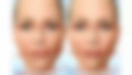 260cc假体隆胸究竟属于什么罩杯？多因素影响下实现A到C甚至D罩杯升级