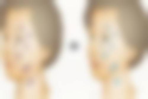 如何效率高去除痘坑疤痕?治疗费用及护理注意事项