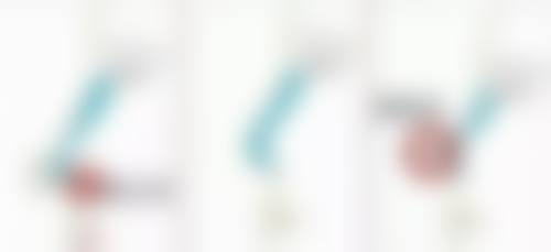 全切双眼皮留疤莫急,把握修复时机特别重要