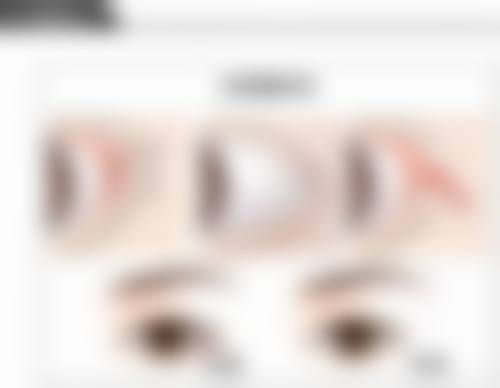 面部抽脂副作用大盘点：其他少见但重度的副作用