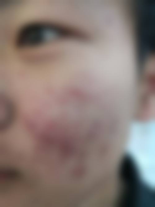 五、马鞍山市人民医院皮肤科实例