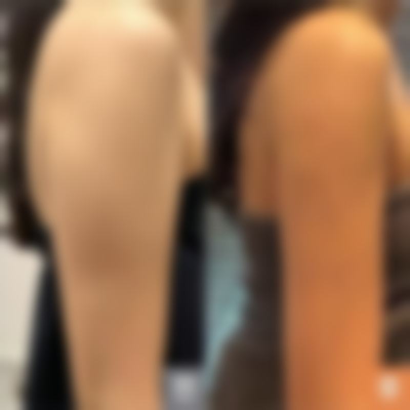 30岁单眼皮变双眼皮原因大揭秘之医美术后与外伤