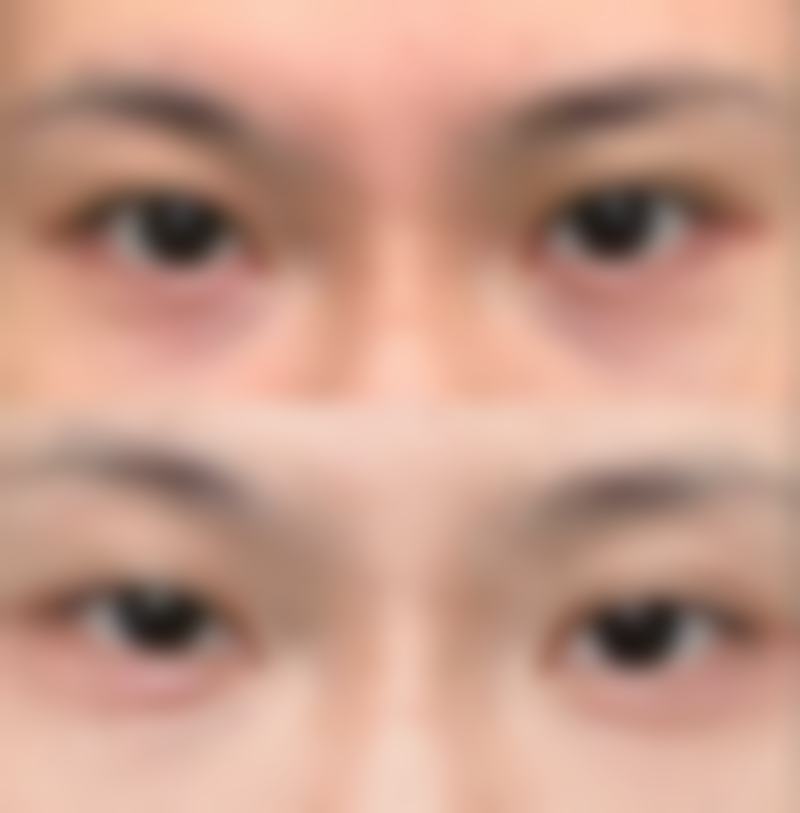 注射瘦脸针用处大揭秘！额外美容作用显著