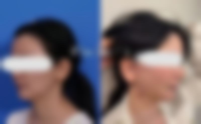 小孩眼袋大不用愁！就医指征要知晓，还你孩子明亮双眸