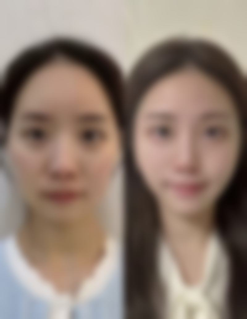 隆鼻哪种材料更自然？硅胶、膨体、自体软骨等各有优势，助你打造自然美鼻 