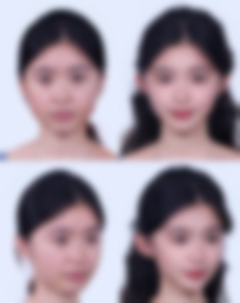 黑眼圈眼袋越来越重度，医美与手术治疗要谨慎