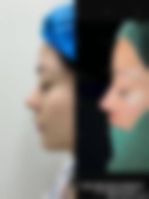 五、济南美释整形医院实例