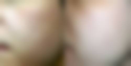 疤痕增生能用艾灸吗？艾灸对不同类型瘢痕的成效