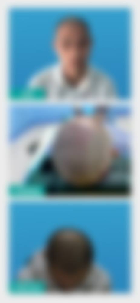 七、徐州高第植发医院价格表：（仅供参考）