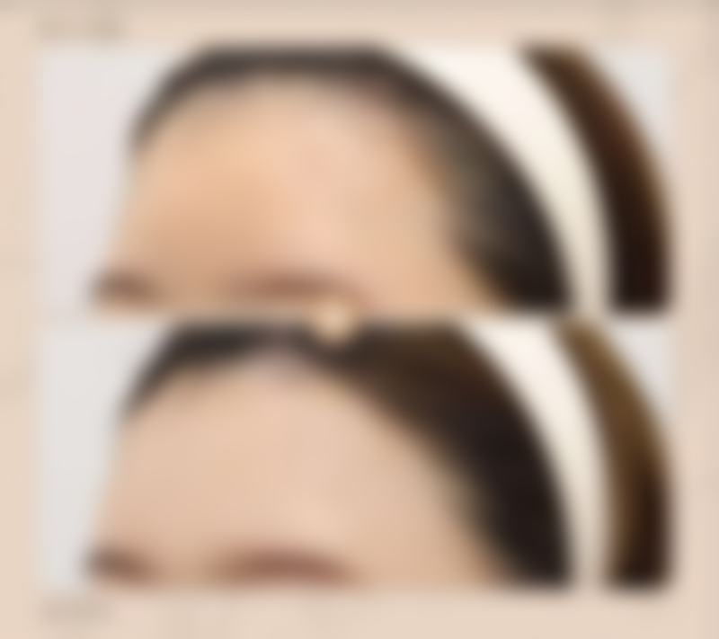 疤痕增生能用艾灸吗？艾灸与其他疗法联合使用