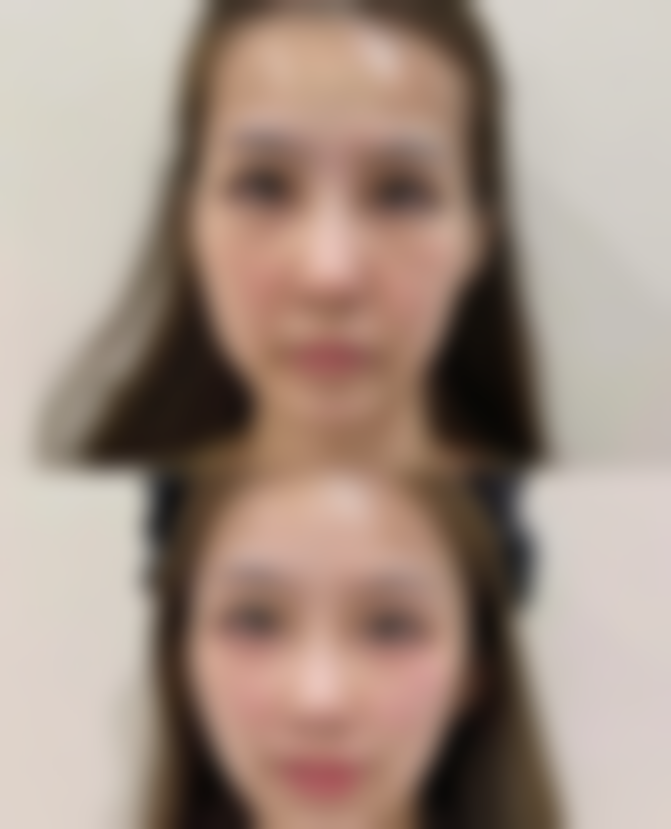 疤痕增生能否用艾灸？艾灸辅助淡化疤痕、缓解瘙痒，适用轻度增生与稳定期瘢痕 