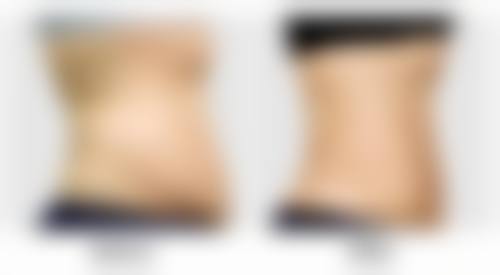 水润嫩肤，玻尿酸的独特功效