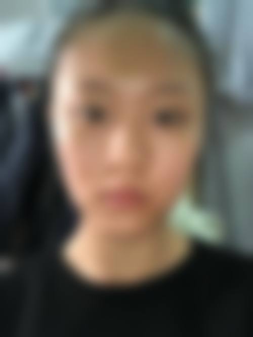 五、石家庄友谊烧伤医院美容整形科实例