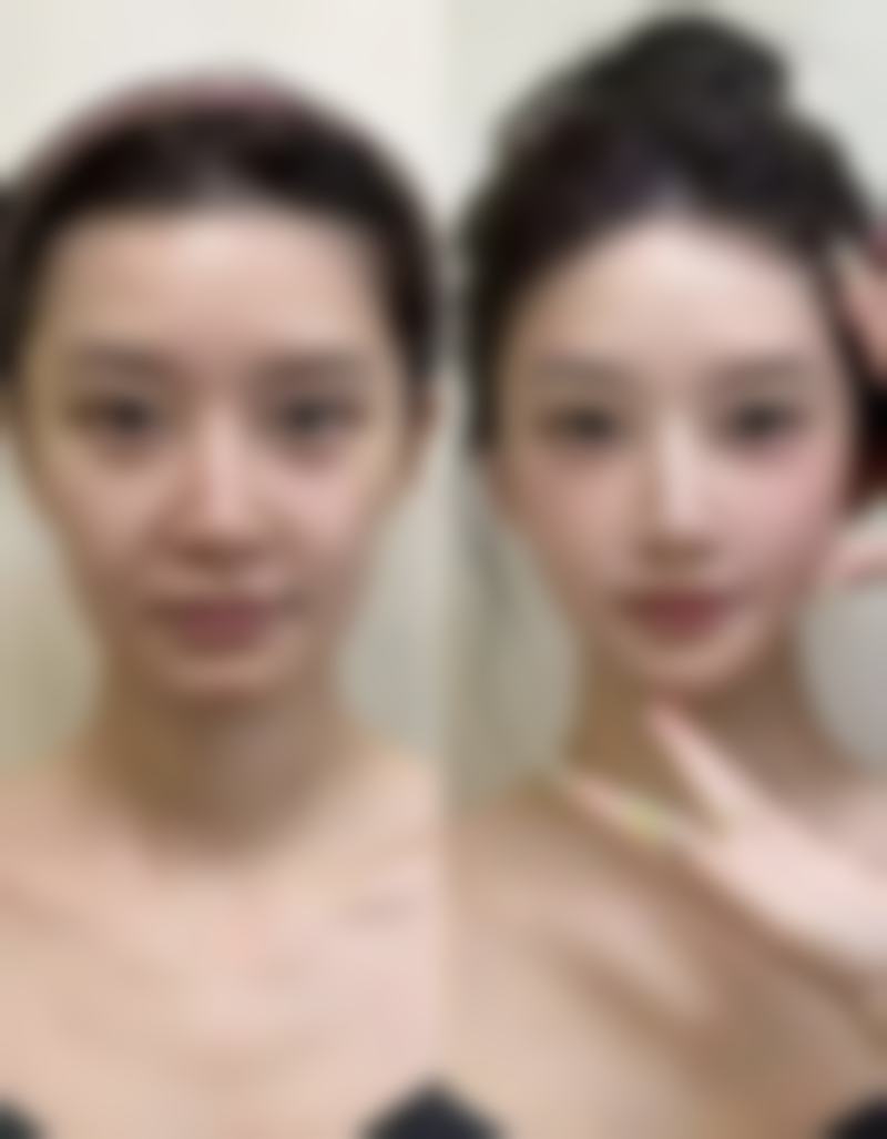 玻尿酸注射除皱效果究竟如何？自然减纹、水润嫩肤，多因素影响持久效果 