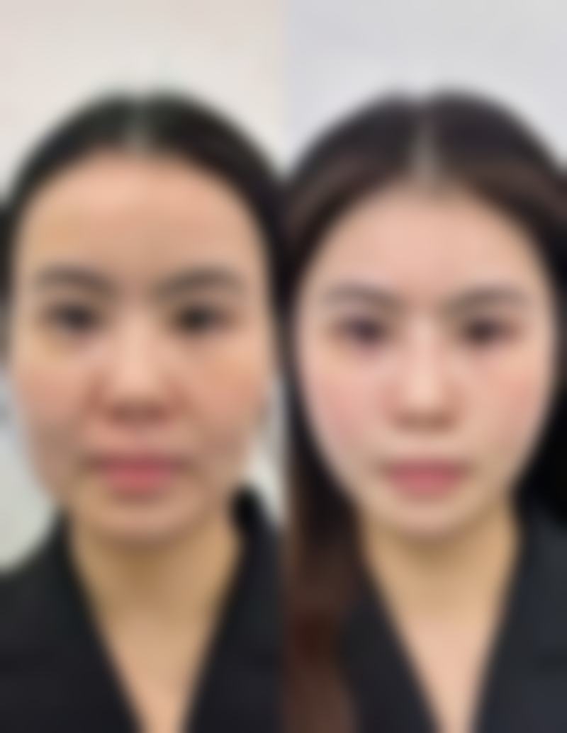 吸脂口修复时间大揭秘：影响修复的核心因素