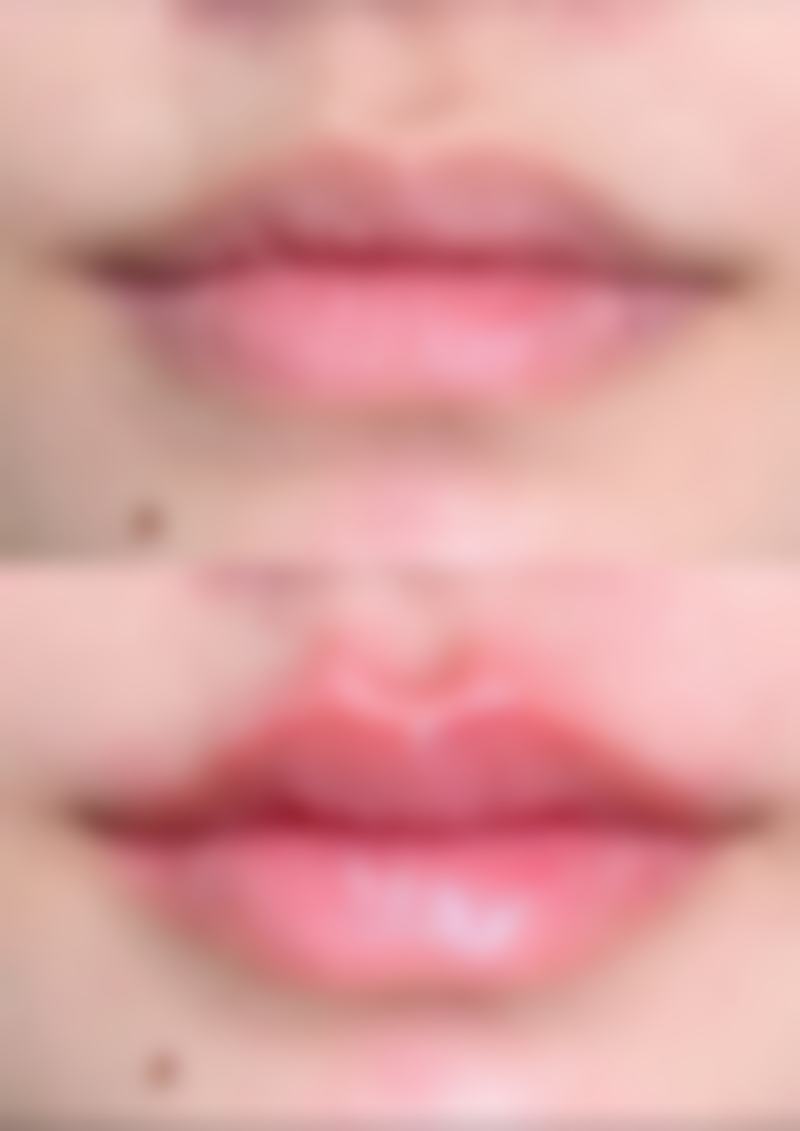 50岁女性隆胸：可选手术方式多