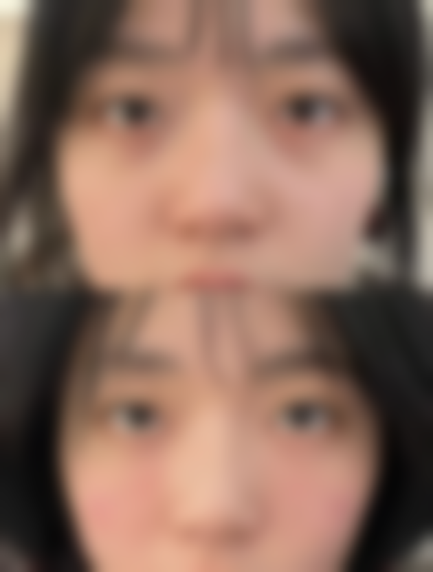 医美/手术治疗，快速告别眼袋