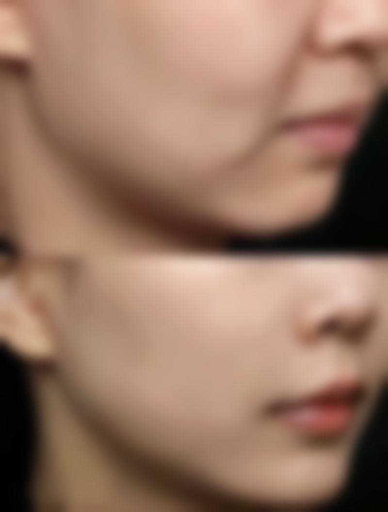 巧妙修复疤痕疙瘩：治疗与护理规范