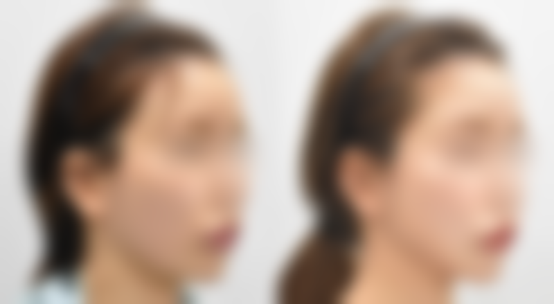 割双眼皮后多久能翻白眼？1 - 3 个月恢复，依个体与护理情况解锁自然眼部活动