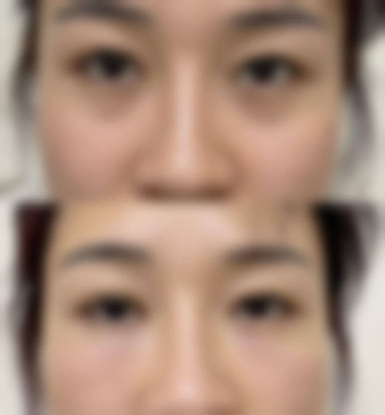 还在烦恼黑眼圈黑眼袋怎么去?正规医美机构来帮忙