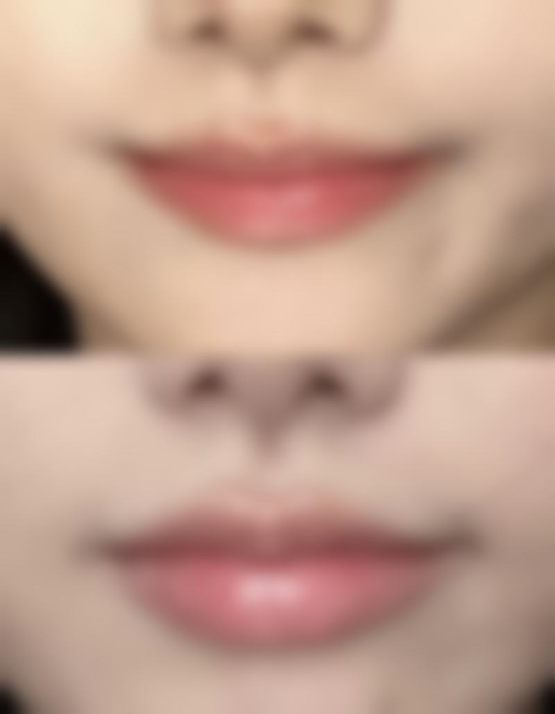 割双眼皮后翻白眼修复的护理要点